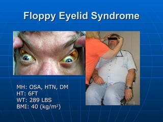 Floppy Eyelid Syndrome MH: OSA, HTN, DM HT: 6FT WT: 289 LBS BMI: 40 (kg/m 2 ) 