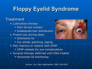 Floppy Eyelid Syndrome Treatment Lubrication therapy Poor lid-eye contact Inadequate tear distribution Protect eye during sleep Ointments hs Fox shield, patching, taping May improve or resolve with CPAP CPAP-related dry eye complications Surgical therapy deferred until OSA treated Horizontal lid shortening 