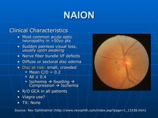 NAION Clinical Characteristics Most common acute optic neuropathy in >50yo pts Sudden painless visual loss,  usually upon awaking Nerve fiber bundle VF defects Diffuse or sectoral disc edema Disc at risk:  small, crowded Mean C/D = 0.2 All ≤ 0.4 Ischemia    Swelling    Compression    Ischemia R/O GCA in all patients Viagra use? TX: None 