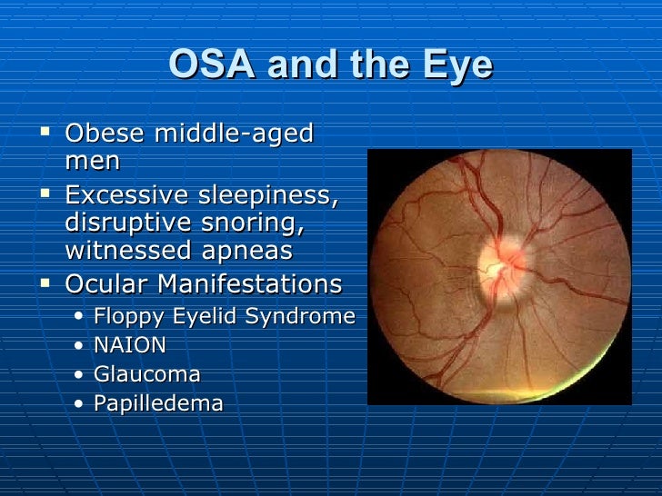Sleep Apnea and the Eye