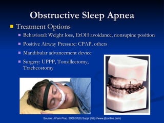 Obstructive Sleep Apnea Treatment Options Behavioral: Weight loss, EtOH avoidance, nonsupine position Positive Airway Pressure: CPAP, others Mandibular advancement device Surgery: UPPP, Tonsillectomy, Tracheostomy 