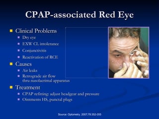 CPAP-associated Red Eye Clinical Problems Dry eye EXW CL intolerance   Conjunctivitis Reactivation of RCE  Causes Air leaks Retrograde air flow  thru nasolacrimal apparatus Treatment CPAP refitting: adjust headgear and pressure Ointments HS, punctal plugs 
