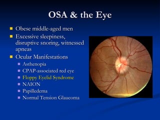 OSA & the Eye Obese middle-aged men Excessive sleepiness, disruptive snoring, witnessed apneas Ocular Manifestations Asthenopia CPAP-associated red eye Floppy Eyelid Syndrome NAION Papilledema Normal Tension Glaucoma 