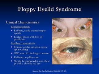 Floppy Eyelid Syndrome Clinical Characteristics Eyelid hyperlaxity Rubbery, easily everted upper eyelids Eyelash ptosis with loss of parallelism Papillary conjunctivitis Chronic ocular irritation, worse upon waking  SPK, mucoid discharge common Rubbing on pillow case Should be suspected in any obese pt with a chronic red eye 