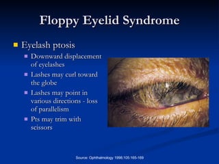 Floppy Eyelid Syndrome Eyelash ptosis Downward displacement of eyelashes Lashes may curl toward the globe Lashes may point in various directions - loss of parallelism Pts may trim with scissors 