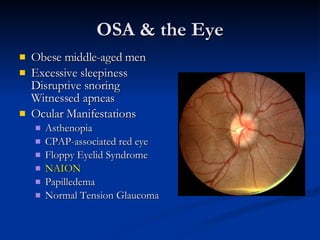 OSA & the Eye Obese middle-aged men Excessive sleepiness Disruptive snoring  Witnessed apneas Ocular Manifestations Asthenopia CPAP-associated red eye Floppy Eyelid Syndrome NAION Papilledema Normal Tension Glaucoma 