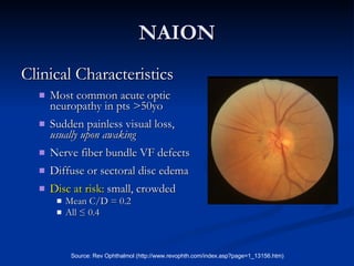 NAION Clinical Characteristics Most common acute optic neuropathy in pts >50yo Sudden painless visual loss,  usually upon awaking Nerve fiber bundle VF defects Diffuse or sectoral disc edema Disc at risk:  small, crowded Mean C/D = 0.2 All ≤ 0.4 