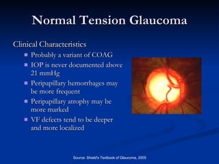 Normal Tension Glaucoma Clinical Characteristics Probably a variant of COAG IOP is never documented above 21 mmHg  Peripapillary hemorrhages may be more frequent Peripapillary atrophy may be more marked  VF defects tend to be deeper and more localized  