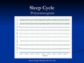 Sleep Cycle Polysomnogram 