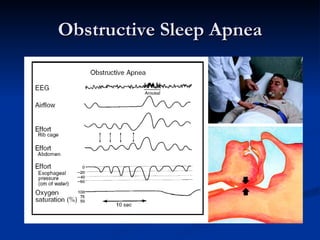 Obstructive Sleep Apnea 
