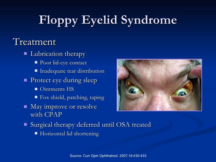 sleep apnea and the