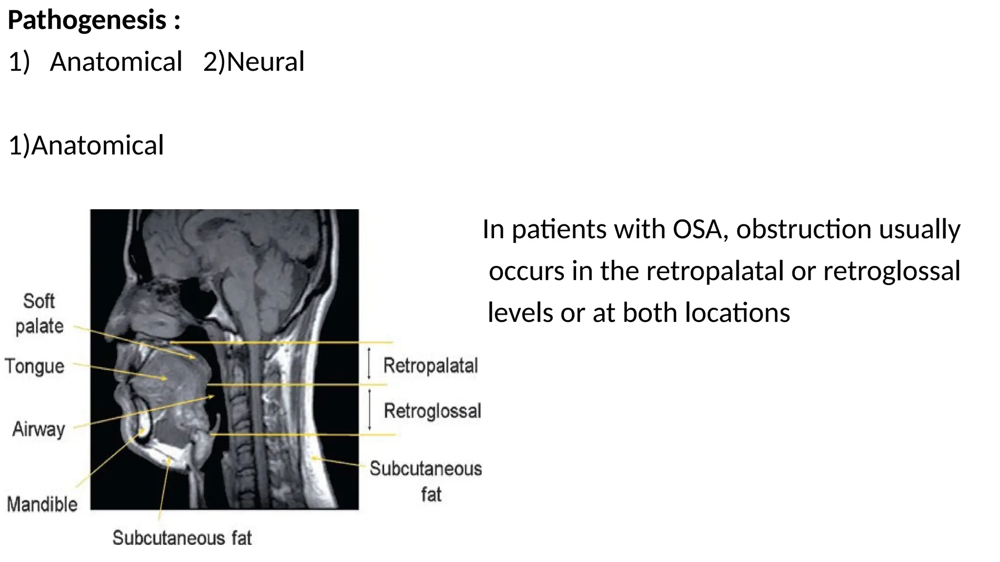 Pathogenesis :
1) Anatomical 2)Neural
1)Anatomical
In patients with OSA, obstruction usually
occurs in the retropalatal or retroglossal
levels or at both locations
 
