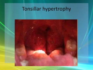 Tonsillar hypertrophy
 