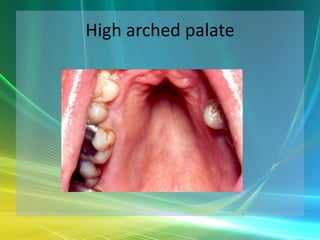 High arched palate
 