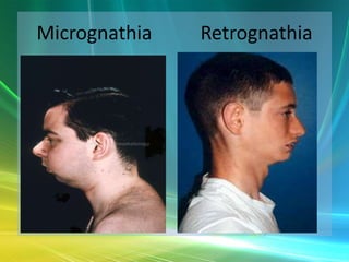 Micrognathia   Retrognathia
 