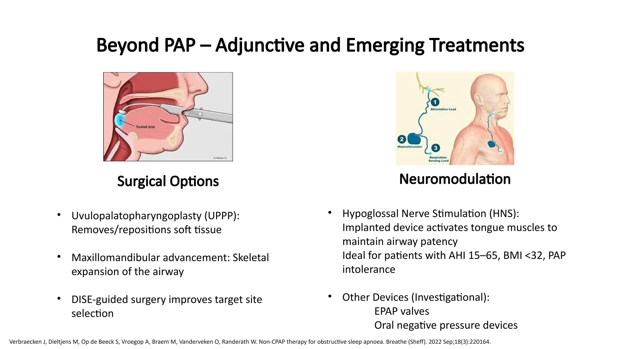 Surgical Options
• Uvulopalatopharyngoplasty (UPPP):
Removes/repositions soft tissue
• Maxillomandibular advancement: Skeletal
expansion of the airway
• DISE-guided surgery improves target site
selection
Beyond PAP – Adjunctive and Emerging Treatments
Neuromodulation
• Hypoglossal Nerve Stimulation (HNS):
Implanted device activates tongue muscles to
maintain airway patency
Ideal for patients with AHI 15–65, BMI <32, PAP
intolerance
• Other Devices (Investigational):
EPAP valves
Oral negative pressure devices
Verbraecken J, Dieltjens M, Op de Beeck S, Vroegop A, Braem M, Vanderveken O, Randerath W. Non-CPAP therapy for obstructive sleep apnoea. Breathe (Sheff). 2022 Sep;18(3):220164.
 