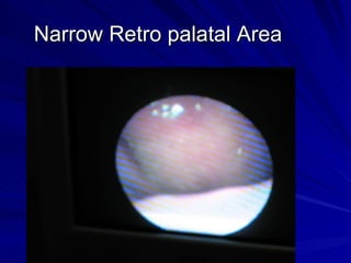 Narrow Retro palatal Area
 