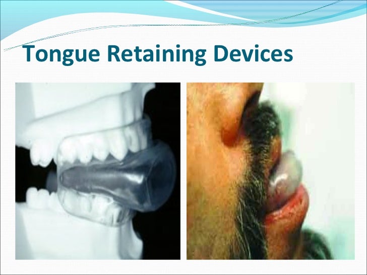 Sleep apnea & its treatment