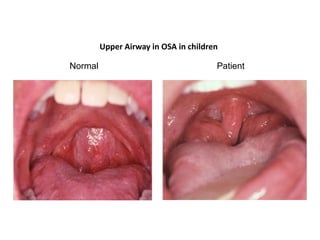 Upper Airway in OSA in children
Normal Patient
 