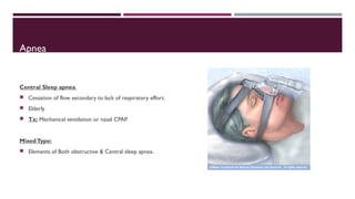 Apnea 
Central Sleep apnea 
 Cessation of flow secondary to lack of respiratory effort. 
 Elderly 
 Tx: Mechanical ventilation or nasal CPAP. 
Mixed Type: 
 Elements of Both obstructive & Central sleep apnea. 
 