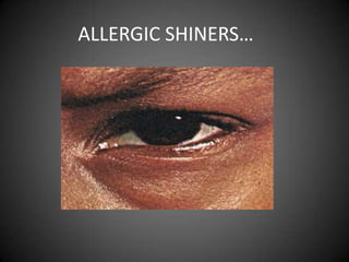 ALLERGIC SHINERS…

 
