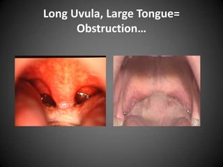 Long Uvula, Large Tongue=
Obstruction…

 