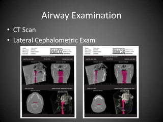 Airway Examination
• CT Scan
• Lateral Cephalometric Exam

 
