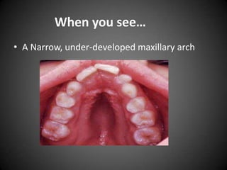 When you see…
• A Narrow, under-developed maxillary arch

 