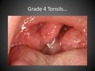 Grade 4 Tonsils…

 