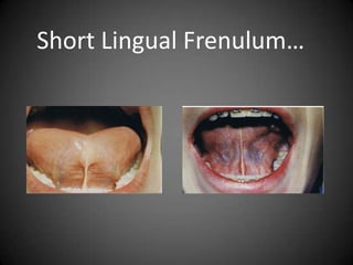 Short Lingual Frenulum…

 