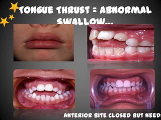 Tongue Thrust = Abnormal
Swallow…

Anterior Bite Closed But needs

 