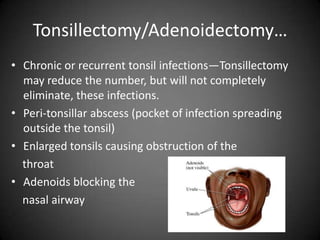 Tonsillectomy/Adenoidectomy…
• Chronic or recurrent tonsil infections—Tonsillectomy
may reduce the number, but will not completely
eliminate, these infections.
• Peri-tonsillar abscess (pocket of infection spreading
outside the tonsil)
• Enlarged tonsils causing obstruction of the
throat
• Adenoids blocking the
nasal airway

 
