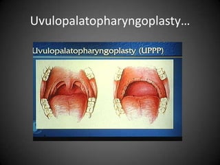 Uvulopalatopharyngoplasty…

 