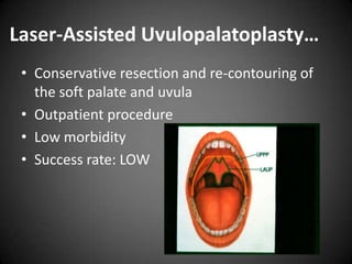 Laser-Assisted Uvulopalatoplasty…
• Conservative resection and re-contouring of
the soft palate and uvula
• Outpatient procedure
• Low morbidity
• Success rate: LOW

 