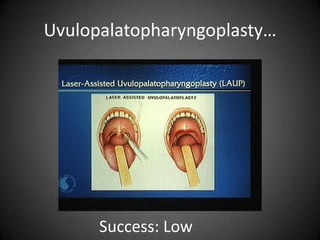 Uvulopalatopharyngoplasty…

Success: Low

 
