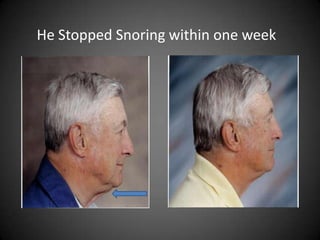 He Stopped Snoring within one week

 