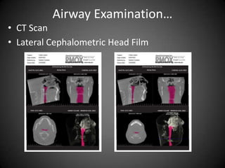 Airway Examination…
• CT Scan
• Lateral Cephalometric Head Film

 
