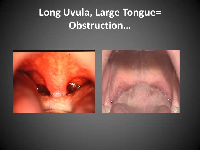 sandy coulson sleep disorder spreecast neck size sleep apnea