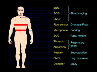 Sleep staging
Oronasal Flow
Snoring
Rate, rhythm
Respiratory
effort
Body position
Leg movement
SaO2
EEG
EOG
Flow sensor
EMG
Microphone
ECG
Thoracic
Abdominal
Position
EMG
Oximeter
 