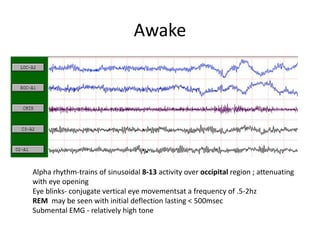 Awake
Alpha rhythm-trains of sinusoidal 8-13 activity over occipital region ; attenuating
with eye opening
Eye blinks- conjugate vertical eye movementsat a frequency of .5-2hz
REM may be seen with initial deflection lasting < 500msec
Submental EMG - relatively high tone
 