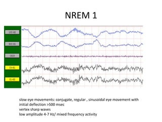 NREM 1
slow eye movements: conjugate, regular , sinusoidal eye movement with
initial deflection >500 msec
vertex sharp waves
low amplitude 4-7 Hz/ mixed frequency activity
 