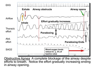 Obstructive Apnea A complete blockage of the airway despite
efforts to breath. Notice the effort gradually increasing ending
in airway opening.
Blood oxygen levels
reduce to < 3% of
basline value
Inhale
Exhale Airway obstructs Airway opens
Paradoxing
Paradoxing Ends
EKG
Airflow
Thoracic
effort
Abd.
effort
SAO2
Effort gradually increases
 