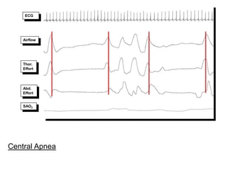 Central Apnea
Airflow
Thor.
Effort
Abd.
Effort
SAO2
ECG
 