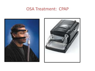 OSA Treatment: CPAP
 