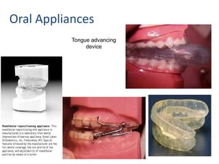 Oral Appliances
Tongue advancing
device
 