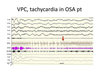 VPC, tachycardia in OSA pt
 