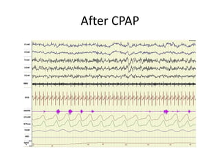 After CPAP
 
