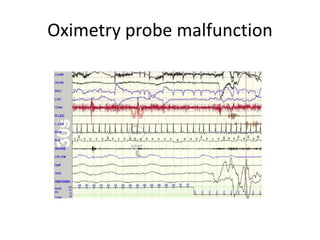 Oximetry probe malfunction
 