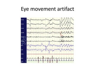 Eye movement artifact
 
