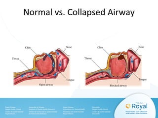 Normal vs. Collapsed Airway
 